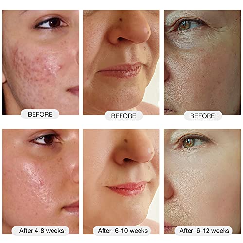 MLAY RF Radio Frequency Facial Massager for Women, Safe for Sensitive Skin | Wrinkle Removal | Skin Rejuvenate | Anti Aging | Tighten Firm Face Eye Neck Arm Thigh Stomach Legs Skin Care Set