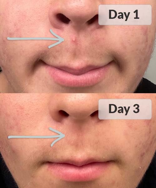 The Luminance RED - ClearBeam Acne Device